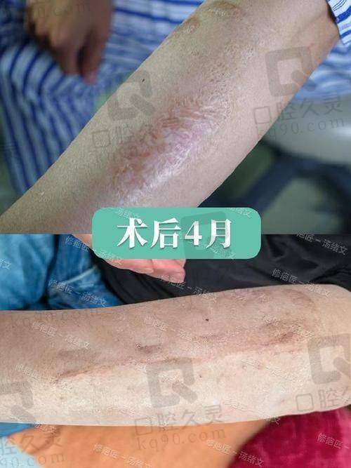 25年深圳鹏程医院疤痕科祛疤技术介绍