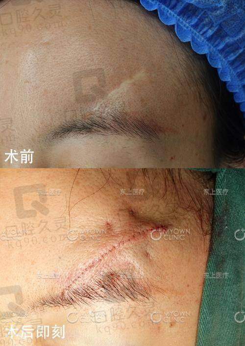 25年深圳鹏程医院疤痕科注射淡疤价格