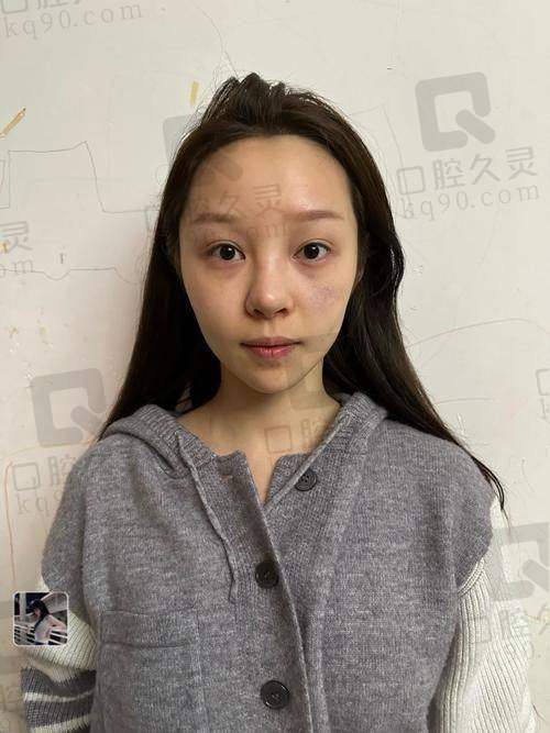 广州可玉罗勇医生做擅长项目怎么样？