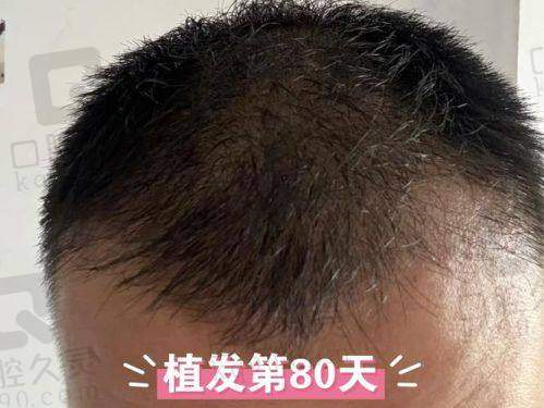 四、厦门万禾丽生植发特色项目