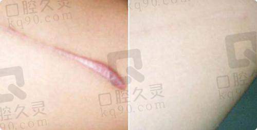 合肥维多利亚整形外科医院——大医院的疤痕修复保护