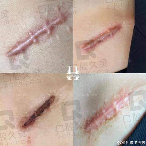 合肥芬格嘉美整形医院——多种手段改善疤痕问题