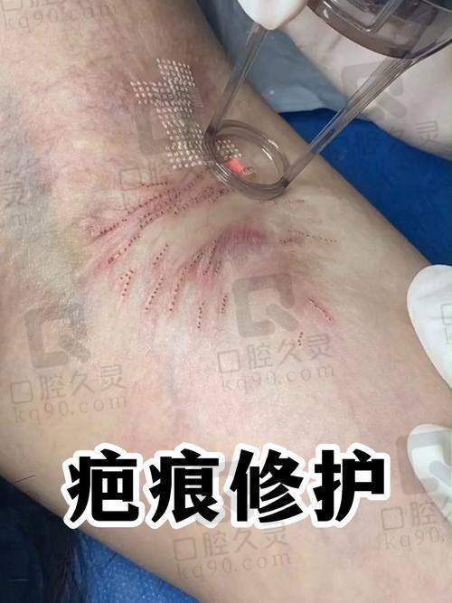 2025年深圳鹏程医院疤痕科全新价格表曝光,多种祛疤项目及技术详情揭秘