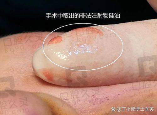吴贞跃医生馒化脸修复怎么样？2000+实例证明其技术精湛、效果自然持久 