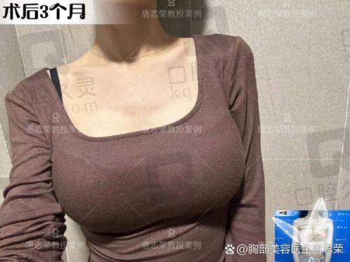 遵义利美康整形医院假体隆胸体验分享，饱满美胸轻松拥有，术后效果自然又持久 