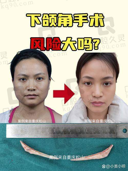 广大医院和韩妃哪个好？广州磨骨整形医院排名解析：广大医院、韩妃医院医生实力如何，手术费用及客户评价一览！
