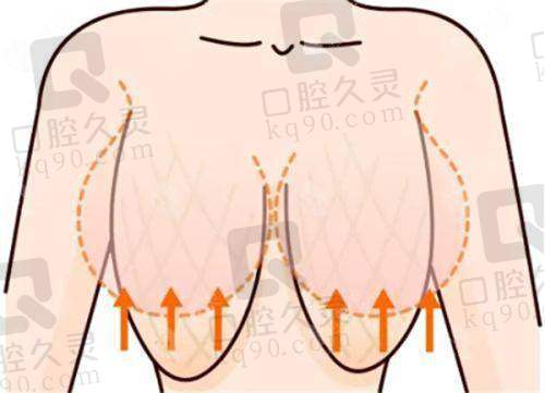 奥美定隆胸取出修复医院有哪些？