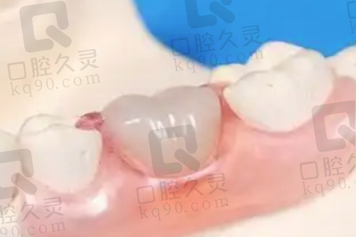 孟溪医生做美国3M250树脂补牙的优势