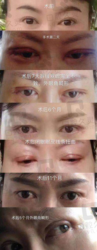 日本医生做双眼皮太自然的持久性