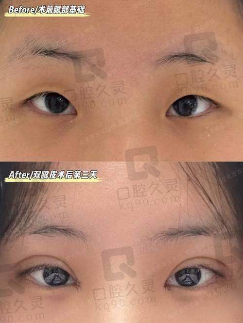 日本医生做双眼皮太自然的术后护理