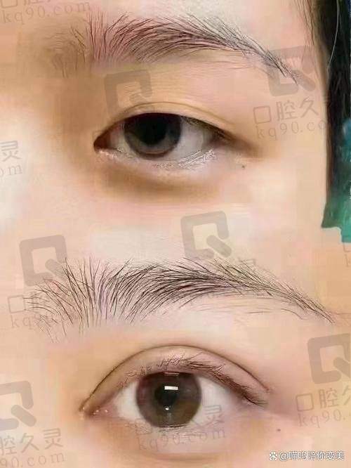 总结：选择日本医生做双眼皮的理由