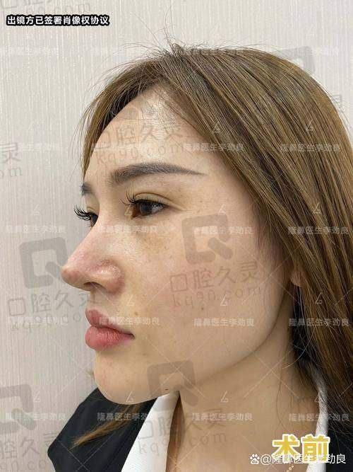 王先成鼻子做的怎么样?真实案例揭秘自然鼻型打造秘诀与个性化技术优势