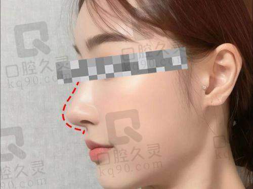 深圳艺星整形医院朱辉院长：丰富经验的鼻整形大师