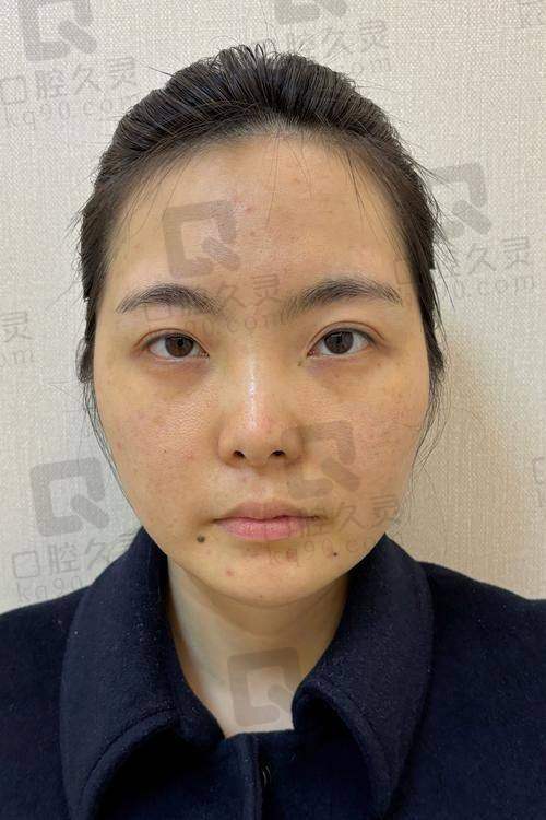 影响深圳富华医院注射玻尿酸价格的因素