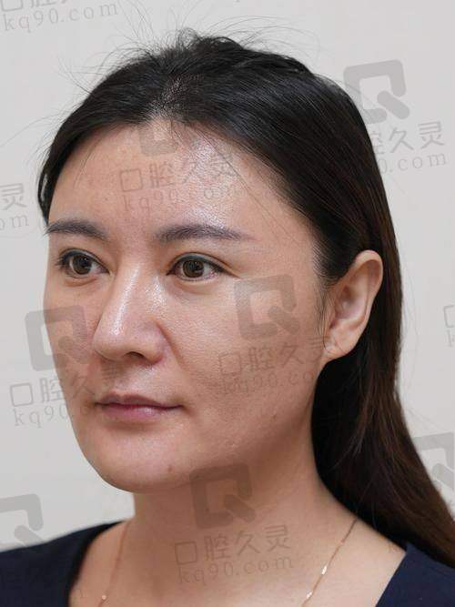 深圳富华医院注射玻尿酸的优势