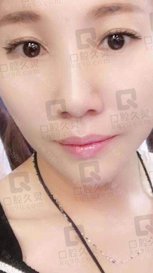 辽宁曙光医院下巴打玻尿酸体验分享，自然塑形效果棒，整个过程轻松又安心 