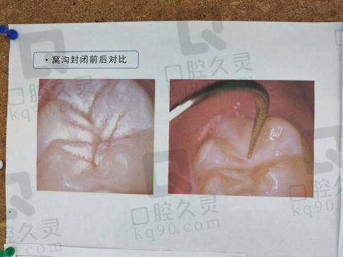 上海泰康拜博口腔美国3M儿童窝沟封闭技术有哪些优势？