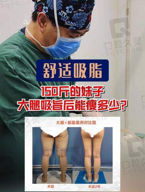 中山美南华美容医院常海医生吸脂真心不错！吃货告别下半身肥胖轻松拥有好身材