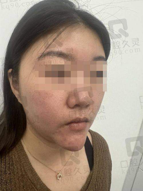 吴贞跃做手术成功率怎么样?高达95%,取生长因子及馒化脸修复经验超丰富