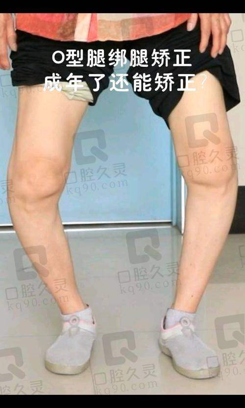 西安腿型矫正医院排名揭晓!西京、交大一附院等前五医院助您重塑美腿