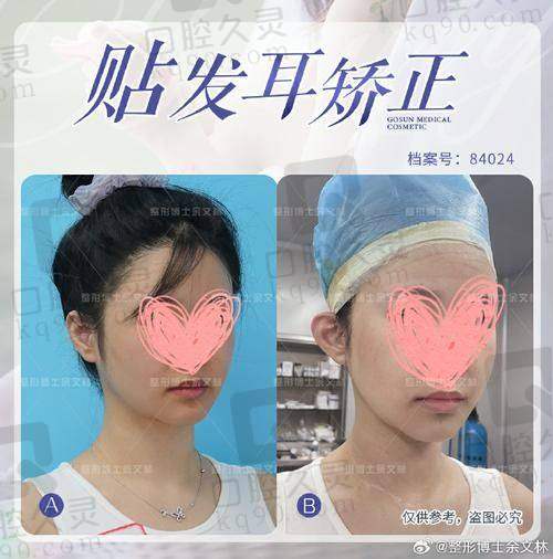 为什么这么多人选择刘嘉锋医生做耳再造？