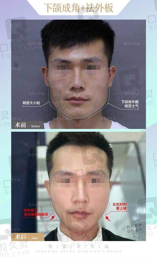 磨骨手术的未来展望