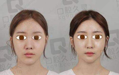 成都李献和腹壁成行术之术后修复与护理