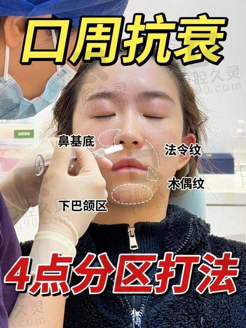 四、线提升提拉复位深层组织：法令纹怎么消除的立竿见影法