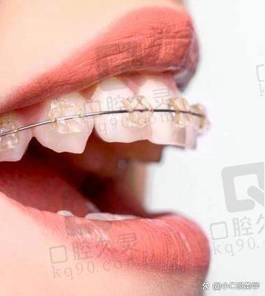 成都铂灵口腔机场门诊矫正价格，金属托槽7800+金属自锁9800+陶瓷半隐形15800+