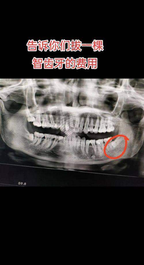 体验太原中诺口腔医院智齿拔除，过程轻松无痛苦，术后恢复快超省心！ 