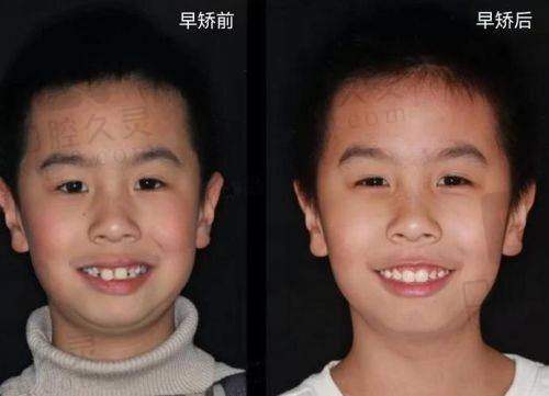 北京禾禾口腔儿童早期干预矫正技术有什么特色？