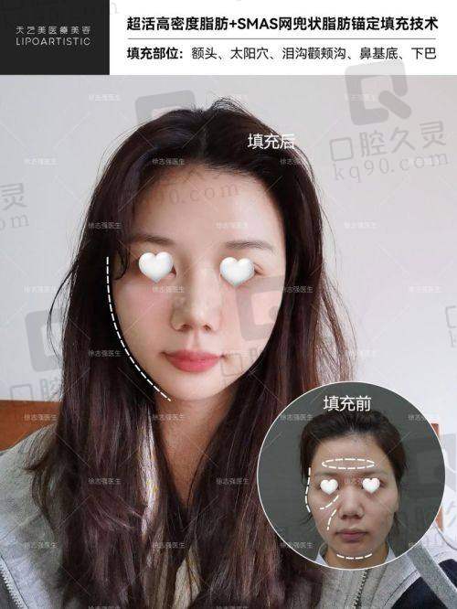 三、不同填充材料的具体情况及面部填充一次能保持多久