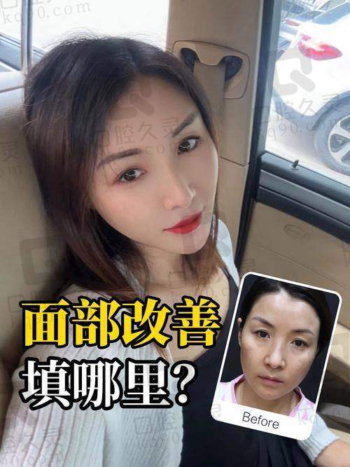 二、影响面部填充一次能保持多久的关键因素