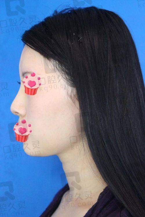 上海嘉漾医疗美容隆鼻价格几何？多种隆鼻方式及优势价格全揭秘 