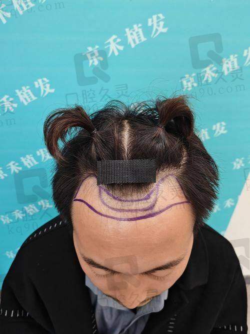 贵阳发博士植发怎么样？专业团队、先进技术、显著效果打造理想毛发状态