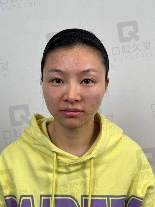 刘李娜全脸填充技术怎么样？10多年经验医生打造自然美感，案例效果超惊艳！ 