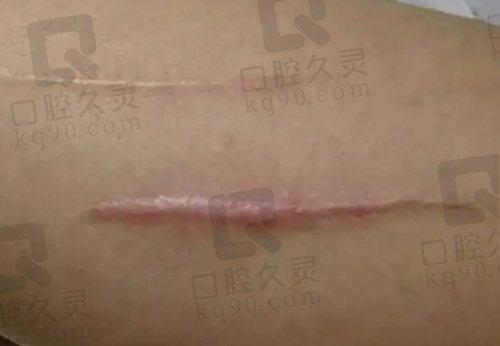 哈尔滨双举疤痕医院手术疤痕修复体验：淡化疤痕效果显著，重塑自信过程超安心 