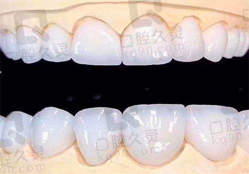三、石景山医院口腔科牙齿美白的患者实例分享