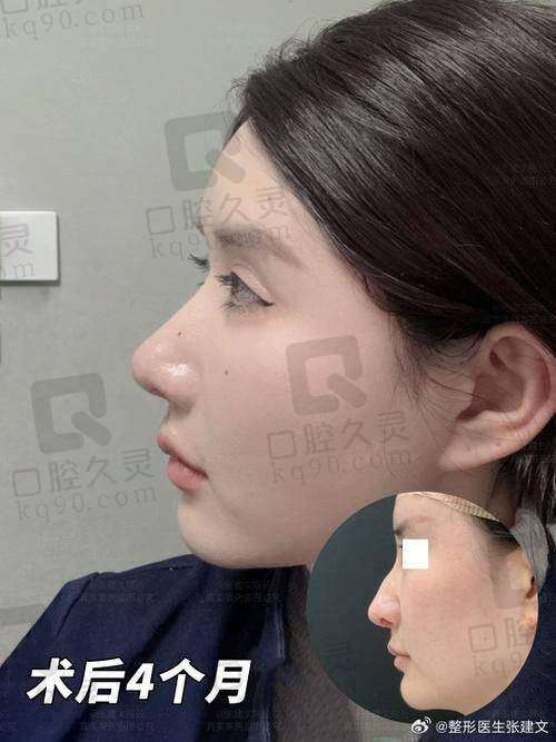 成都王宇琨做鼻子的成效和价格匹配吗？