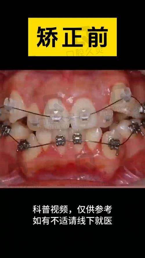 天津爱之和口腔刘承医生牙齿矫正怎么样?
