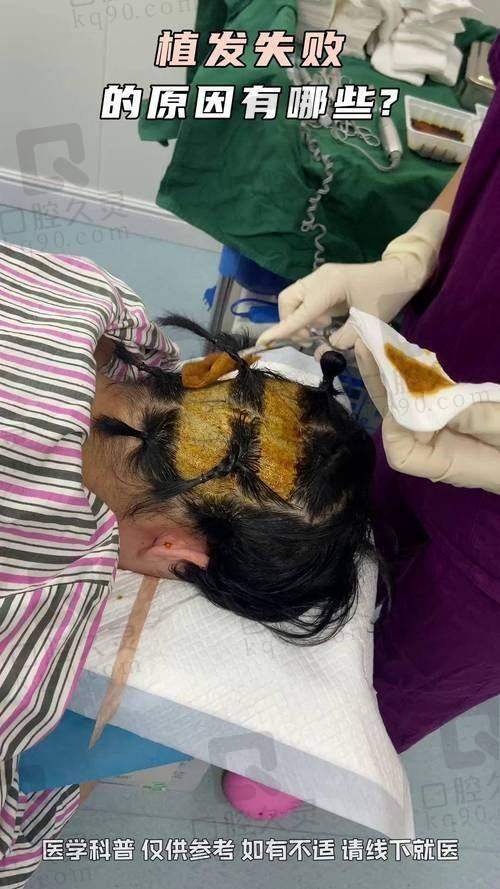 一、广州碧莲盛植发怎么样?