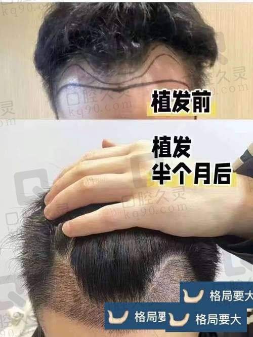 六、广州碧莲盛植发价格表:(仅供参考)