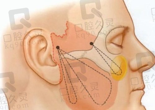 3万多找丁昆琨做面部拉皮值不值？价格、特色、案例全揭秘