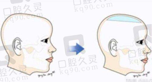 如何选择适合自己的双眼皮整形