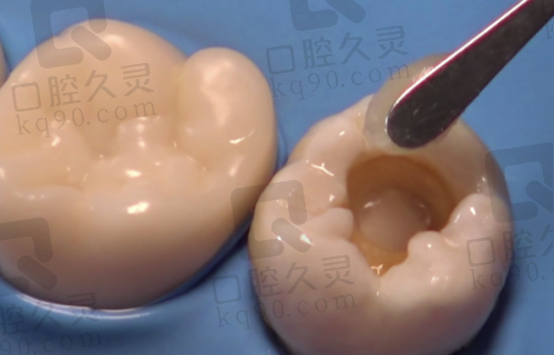 为什么选择上海永华口腔进行进口树脂补牙？