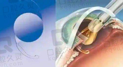 双眼皮整形价格的影响因素