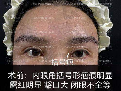 广州研媄荟医疗美容门诊部潘贰医生眼部整形怎么样？