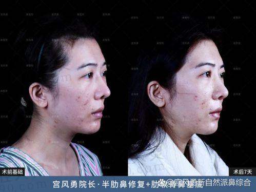 昆明韩辰医疗美容医院陈曦鼻部修复26830元起，专业团队定制方案重塑自然美鼻