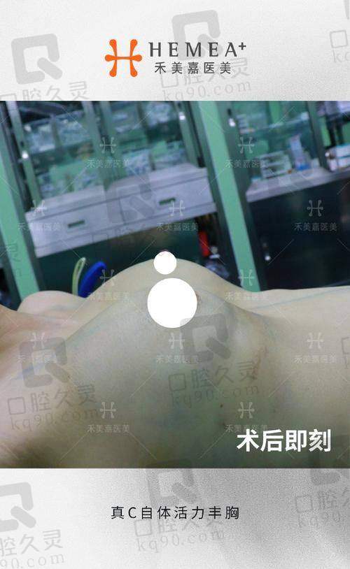 傲诺拉：高端乳房假体的代表