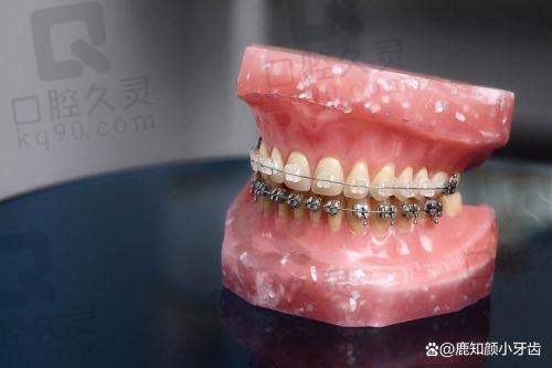 隐形牙套不咬胶的后果之五：影响美观